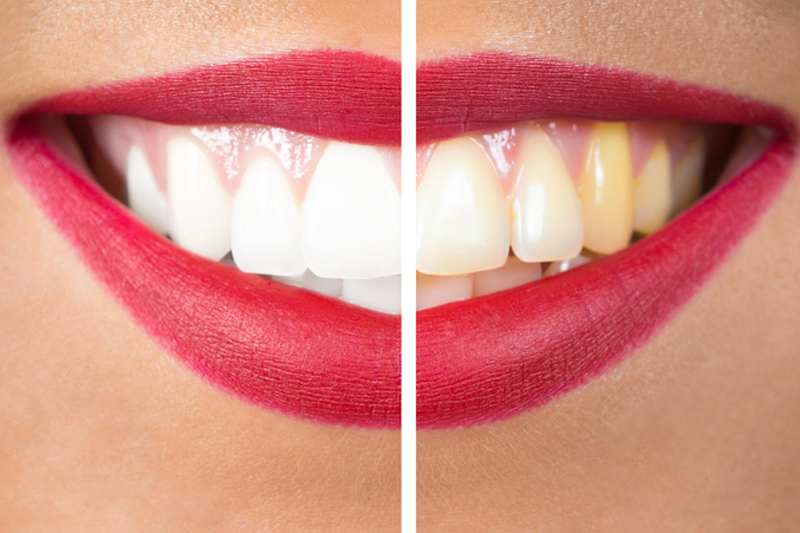 Teeth Whitening | Dentist in Thousand Oaks, CA